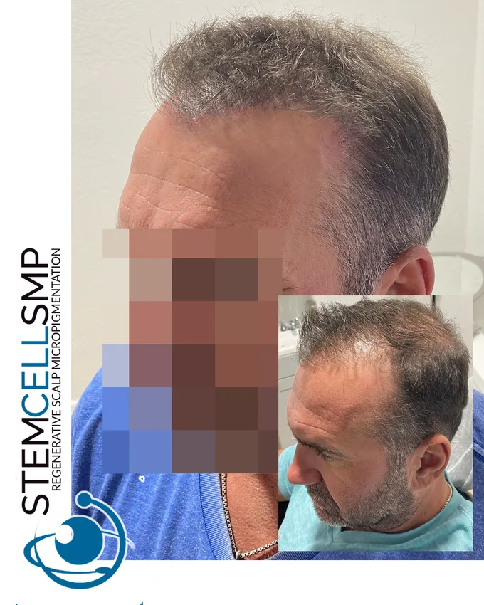 Stem Cell SMP Hair Treatment